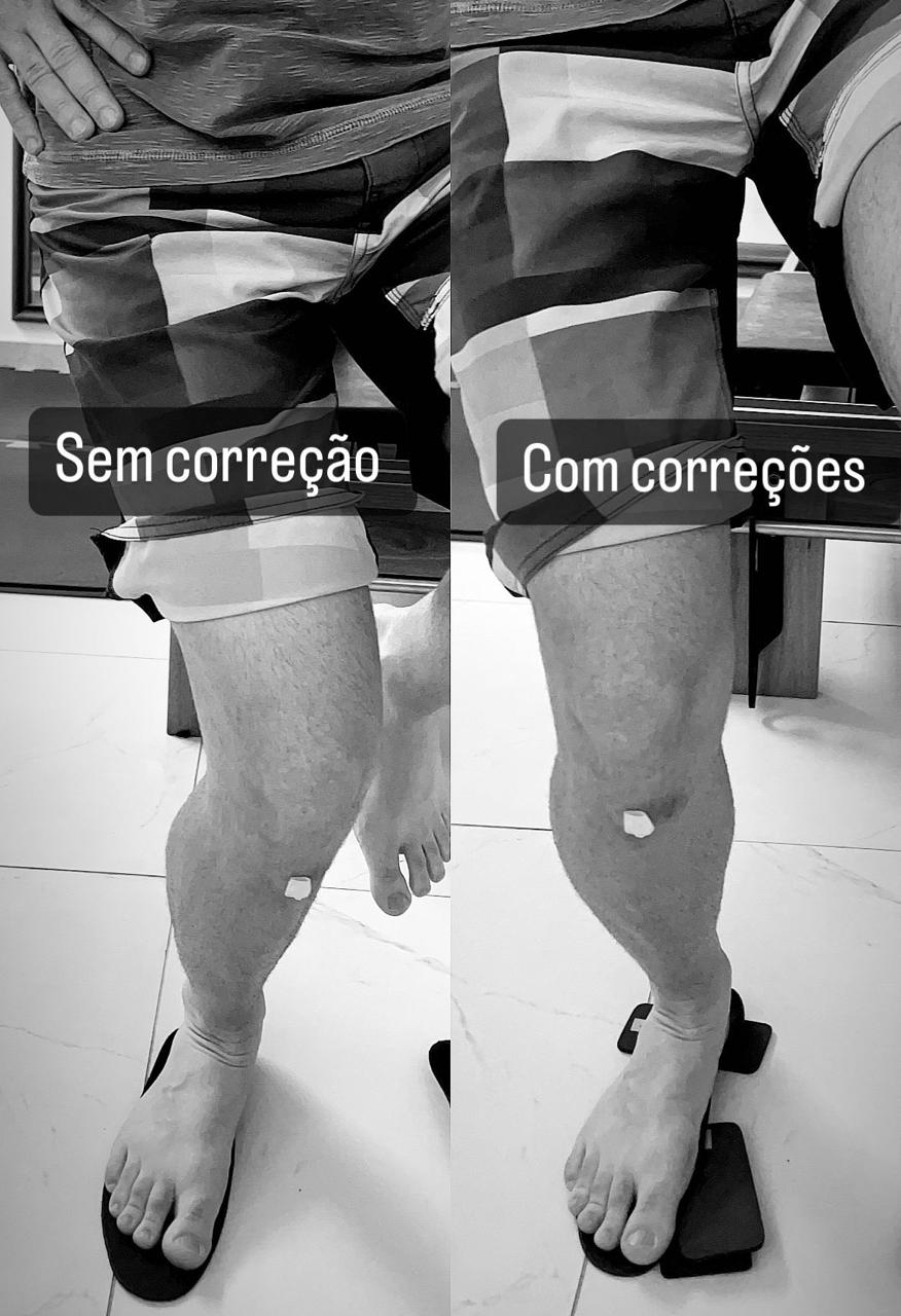 Curso prescrição de Palmilhas e calçados Ortopédicos personalizados